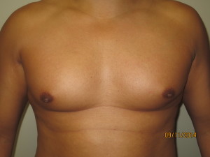 Male Nipple Reduction Newport Beach