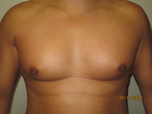Nipple Reduction Before and After | Grover Aesthetics