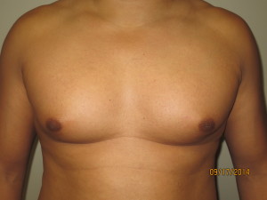 Nipple Reduction Before and After | Grover Aesthetics