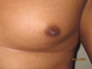 Nipple Reduction Before and After 02 | Grover Aesthetics