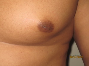 Nipple Reduction Before and After 02 | Grover Aesthetics