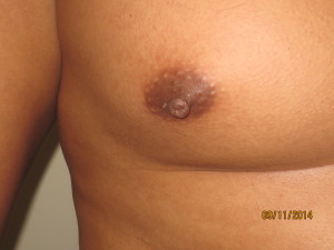 Nipple Reduction Before and After 02 | Grover Aesthetics