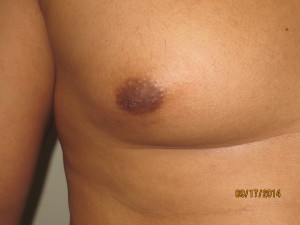 Nipple Reduction Before and After 02 | Grover Aesthetics