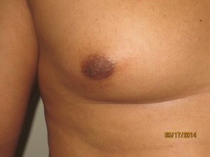 Nipple Reduction Before and After 02 | Sanjay Grover MD FACS