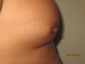 Nipple Reduction Before and After 02 | Grover Aesthetics