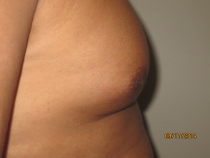 Nipple Reduction Before and After 02 | Grover Aesthetics