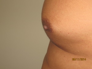 Nipple Reduction Before and After 02 | Grover Aesthetics