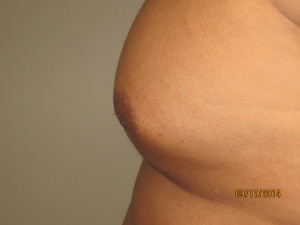 Nipple Reduction Before and After 02 | Grover Aesthetics