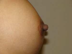 Nipple Reduction Before and After 04 | Grover Aesthetics
