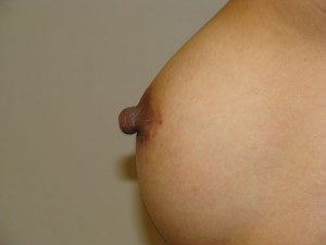 Nipple Reduction Before and After 04 | Grover Aesthetics