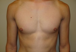 Nipple Reduction Before and After 02 | Sanjay Grover MD FACS