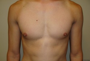 Nipple Reduction Before and After | Grover Aesthetics