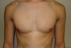 Nipple Reduction Before and After | Grover Aesthetics