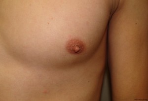 Nipple Reduction Before and After 05 | Grover Aesthetics