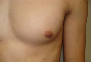 Nipple Reduction Before and After 05 | Grover Aesthetics