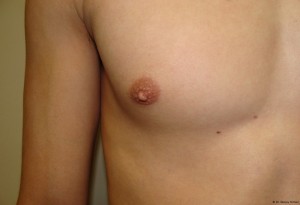 Nipple Reduction Before and After 05 | Grover Aesthetics