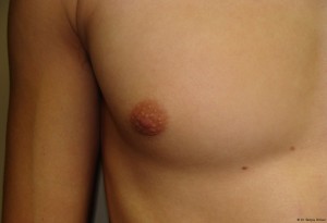 Nipple Reduction Before and After 05 | Grover Aesthetics