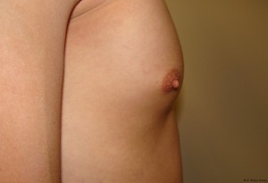 Nipple Reduction Before and After 05 | Grover Aesthetics