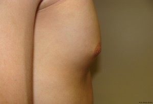 Nipple Reduction Before and After 05 | Grover Aesthetics