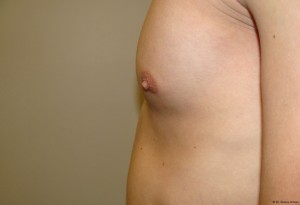 Nipple Reduction Before and After 05 | Grover Aesthetics