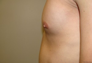 Nipple Reduction Before and After 05 | Sanjay Grover MD FACS