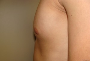 Nipple Reduction Before and After 05 | Grover Aesthetics