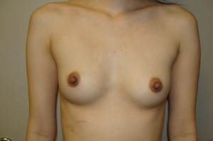 Nipple Reduction Before and After | Grover Aesthetics