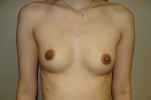 Nipple Reduction Before and After | Grover Aesthetics