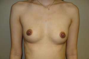 Nipple Reduction Before and After 06 | Sanjay Grover MD FACS