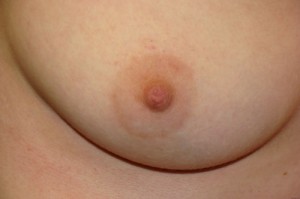 Nipple Reduction Before and After | Grover Aesthetics