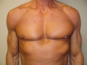 Nipple Reduction Before and After 05 | Sanjay Grover MD FACS
