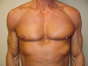 Nipple Reduction Before and After | Grover Aesthetics