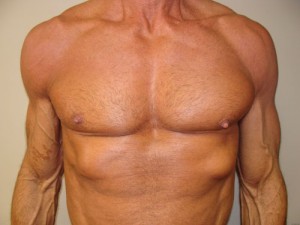 Nipple Reduction Before and After | Grover Aesthetics