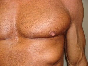 Nipple Reduction Before and After 09 | Grover Aesthetics