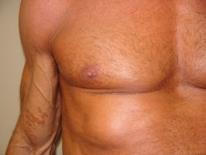 Nipple Reduction Before and After 09 | Grover Aesthetics
