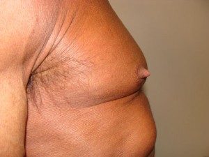 Nipple Reduction Before and After 09 | Grover Aesthetics