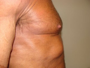 Nipple Reduction Before and After 09 | Sanjay Grover MD FACS