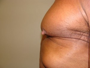Nipple Reduction Before and After 09 | Grover Aesthetics
