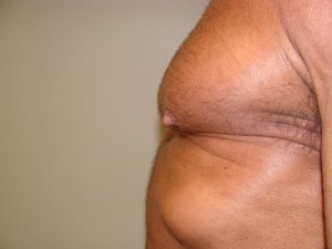 Nipple Reduction Before and After 09 | Sanjay Grover MD FACS