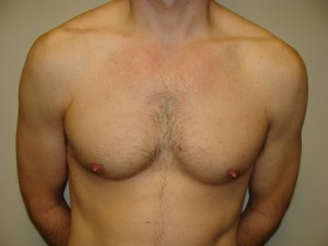 Nipple Reduction Before and After | Grover Aesthetics