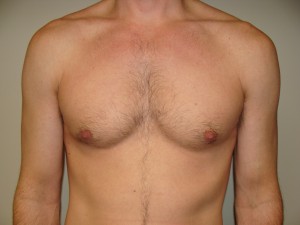 Nipple Reduction Before and After | Grover Aesthetics