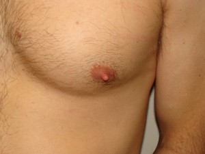 Nipple Reduction Before and After 10 | Grover Aesthetics