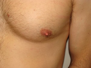 Nipple Reduction Before and After 10 | Sanjay Grover MD FACS