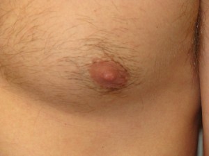 Nipple Reduction Before and After 10 | Grover Aesthetics