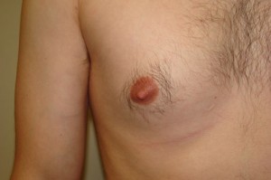 Nipple Reduction Before and After 10 | Sanjay Grover MD FACS
