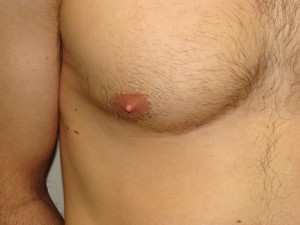 Nipple Reduction Before and After 10 | Grover Aesthetics
