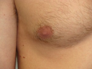 Nipple Reduction Before and After 10 | Grover Aesthetics