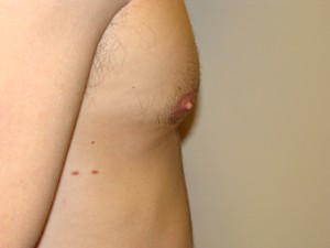 Nipple Reduction Before and After 10 | Grover Aesthetics