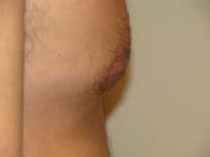 Nipple Reduction Before and After 10 | Grover Aesthetics