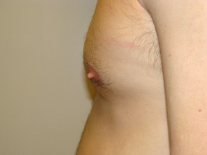 Nipple Reduction Before and After 10 | Grover Aesthetics